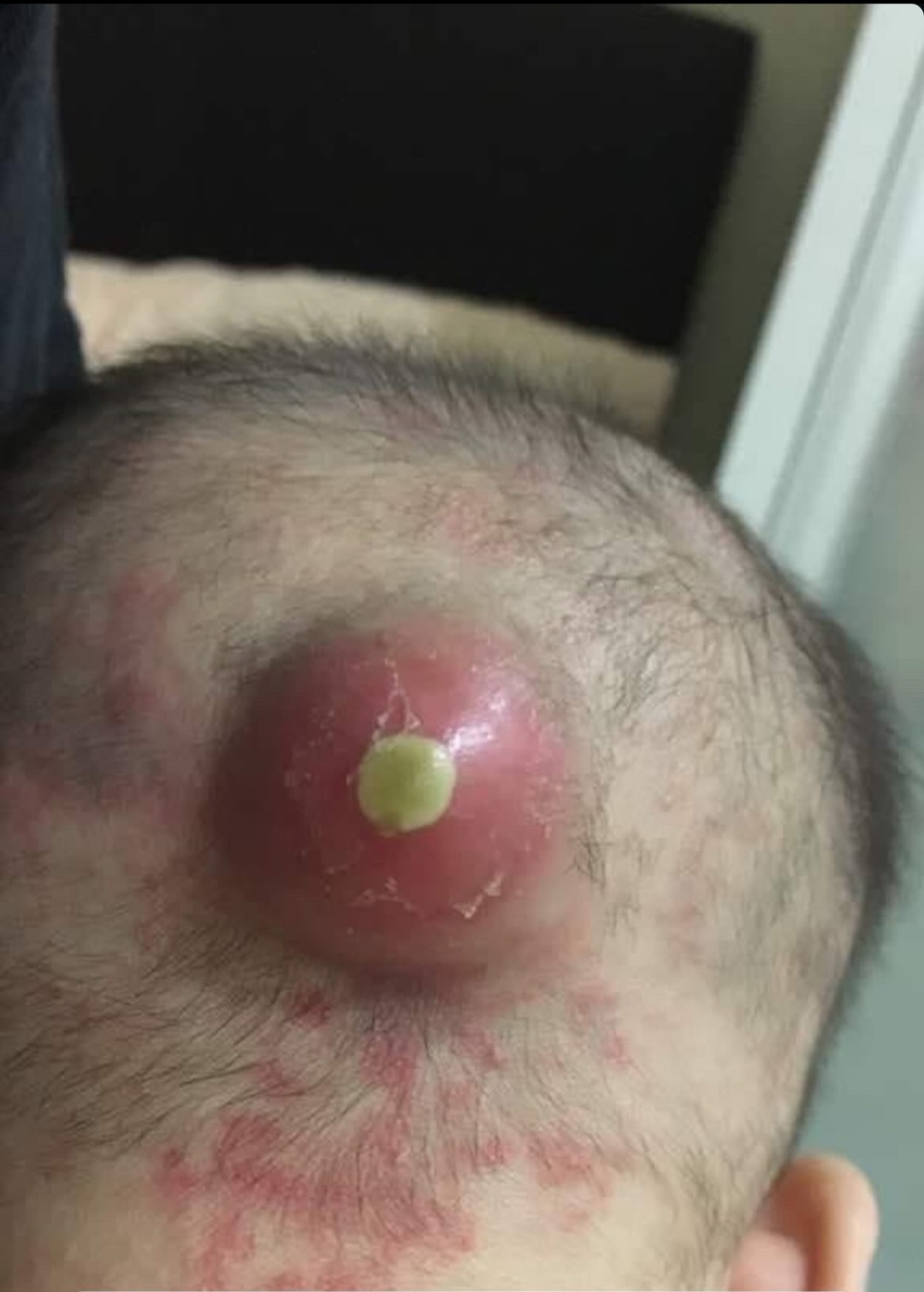 CYST ON BACK HEAD